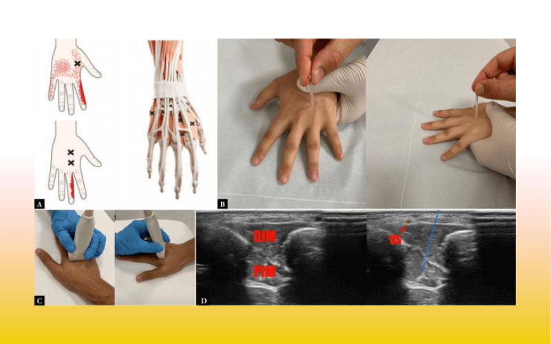 2. Musculos interoseo tempo formacion ecografia.png